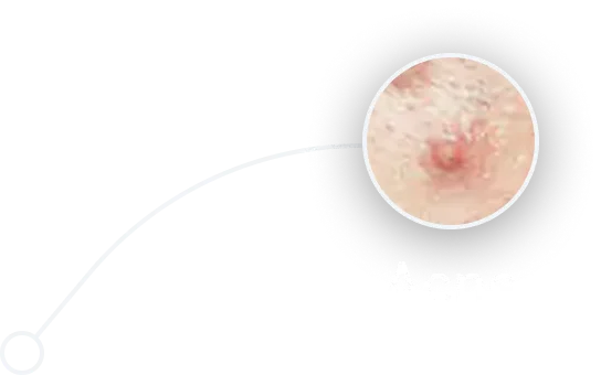 acne